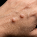 mezquinos en la piel